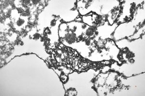 M,50y. | Pneumocystis carinii - lung